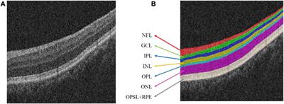 DW-Net: Dynamic Multi-Hierarchical Weighting Segmentation Network for Joint Segmentation of Retina Layers With Choroid Neovascularization